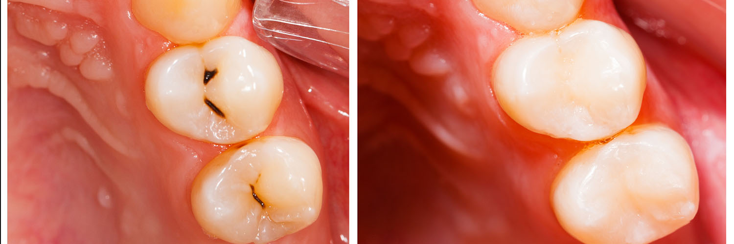 The image shows a close-up view of a person s mouth with teeth and gums visible, highlighting a dental issue where one tooth has been removed and there are signs of decay or infection on other teeth.