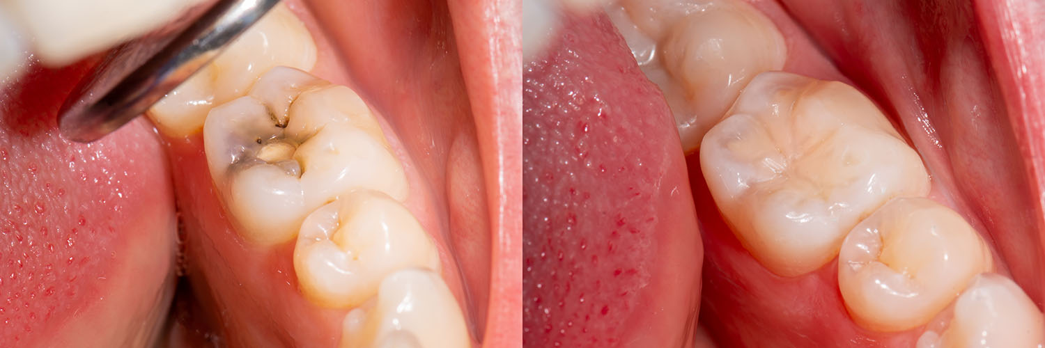 The image shows a close-up view of a human mouth with visible teeth and gums, taken from an overhead angle.